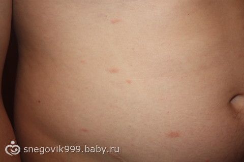 Еле заметная сыпь у ребенка что это Еле заметная сыпь у ребенка что это