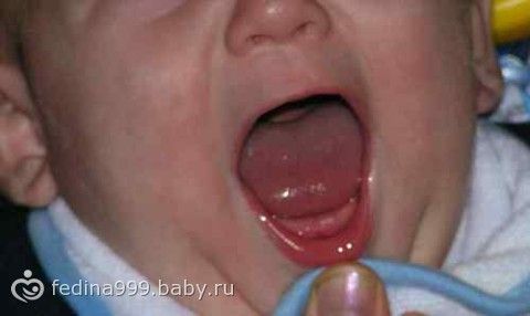 Что делать когда у ребенка раздражение на щеках