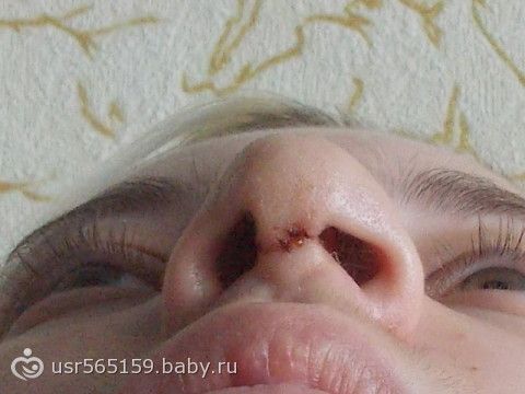 Для чего клеить стрипы при ринопластике Для чего клеить стрипы при ринопластике