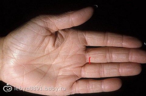 Как избавиться от синих вен на ногах