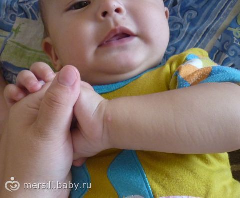 У годовалого ребёнка угри У годовалого ребёнка угри