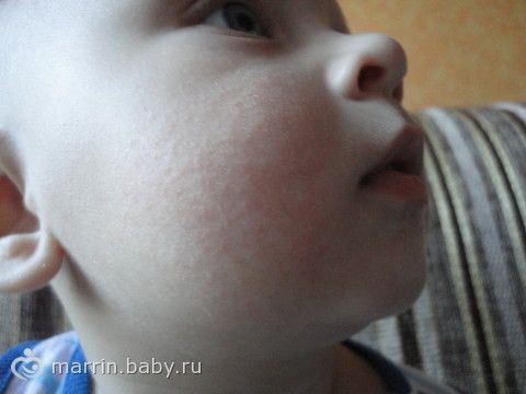 Прыщи у ребенка на клубнику Прыщи у ребенка на клубнику
