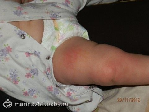 Сыпь на пентаксим у ребенка Сыпь на пентаксим у ребенка