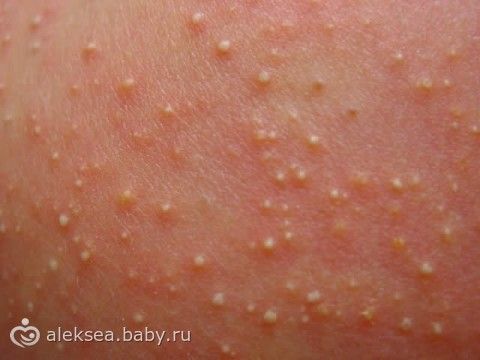 Посев на грибы с кожи Посев на грибы с кожи