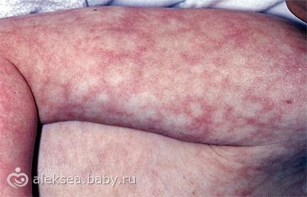 Атопический дерматит у грудничка как лечить что мне есть