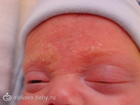 Причина заболевания атопического дерматита