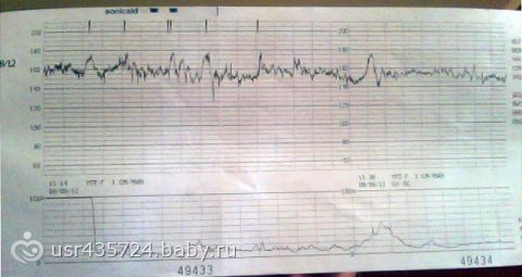 Беременность 33 неделя тахикардия