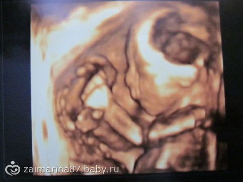 Узи 22 неделя беременности 3д узи