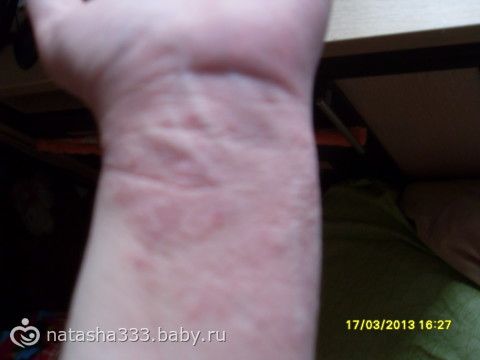 Если почесать кожу то появляются волдыри 96