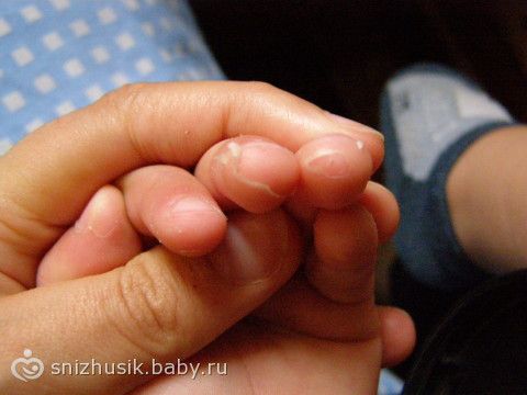 Слазить кожа с пальцев ног у ребенка Слазить кожа с пальцев ног у ребенка
