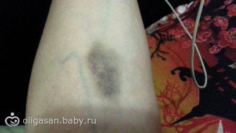 Что делать если воспалились вены на ногах и болят