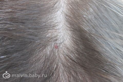 Папилломы что это за болезнь
