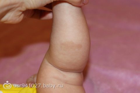Родимое пятно косметический дефект или опасный симптом 67 Родимое пятно косметический дефект или опасный симптом 65