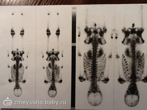 Сбор приостановлен. Полине Букиной нужна ваша помощь! не проходите мимо!