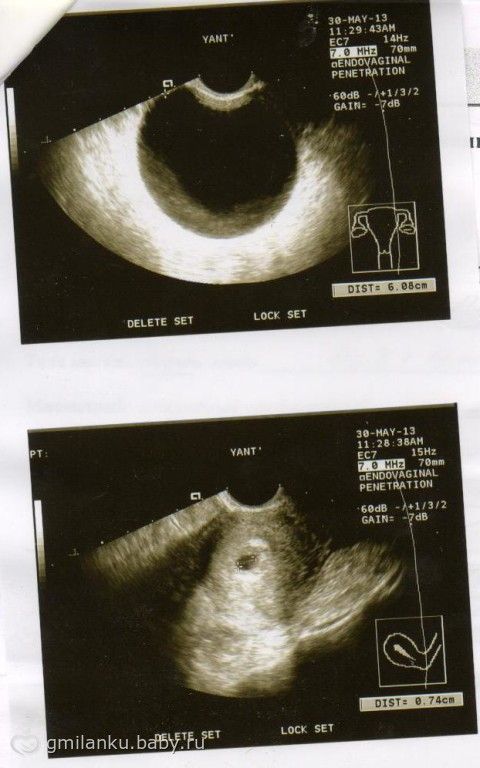 Тянет яичник при беременности на ранних. Яичники при беременности на ранних сроках. Киста и беременность на УЗИ. Кисту спутали с беременностью.