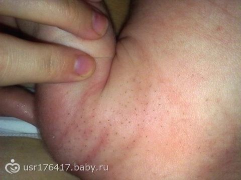 вам необходимо покраснения на яичках у грудничка организации