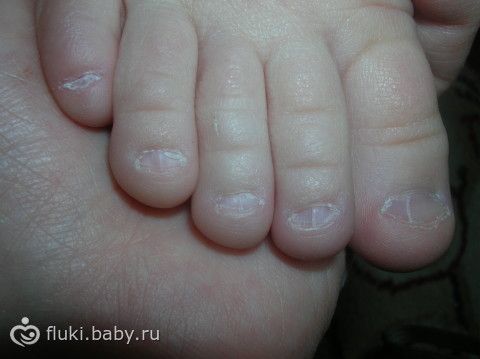 Ногти На Ногах Детей Фото