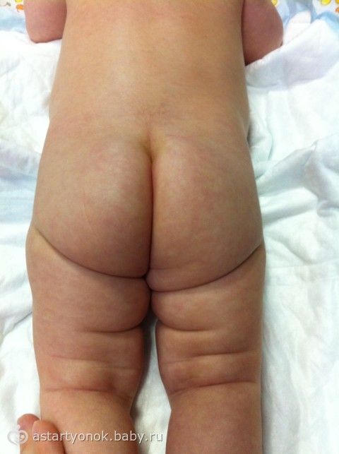 «Несимметричные складки на ножках младенца — это повод для тревоги?» - биржевые-записки.рф | PARENTS